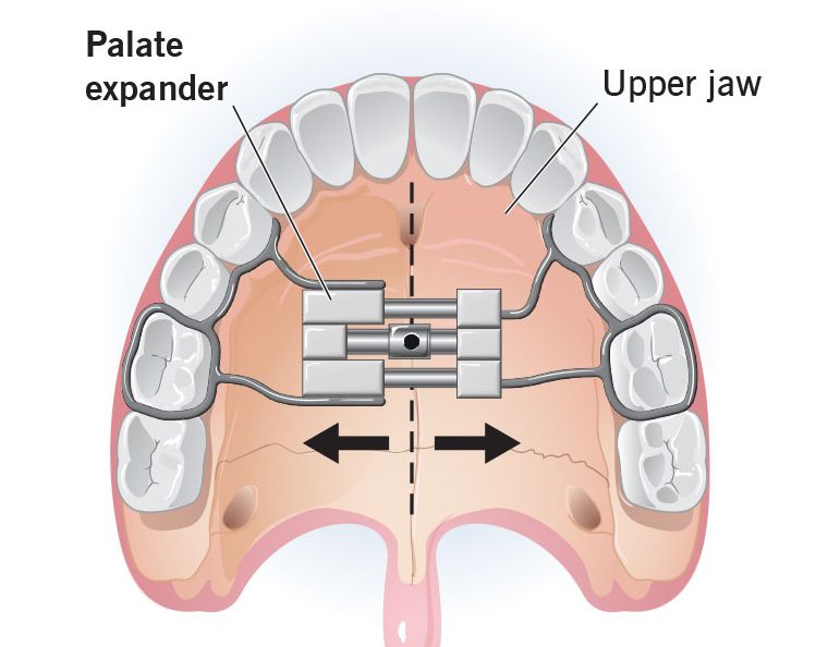 23502 Palate Expander 1