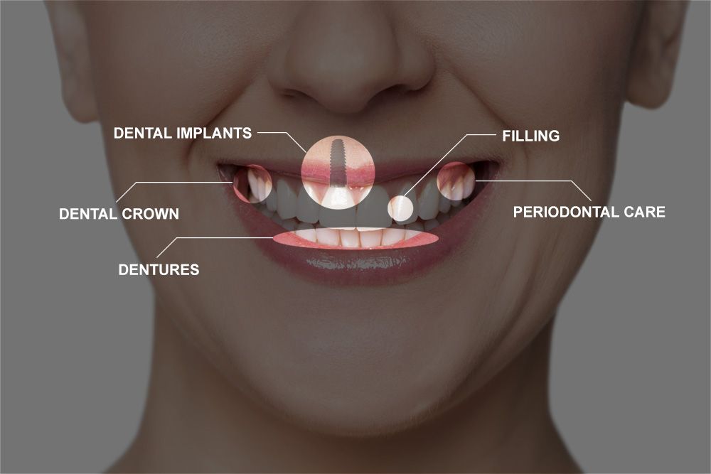 Full_Mouth_Recon_Diagram_v2 Full Mouth Recon Diagram V2