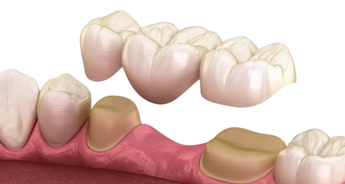 Traditional-Dental-Bridge Traditional Dental Bridge