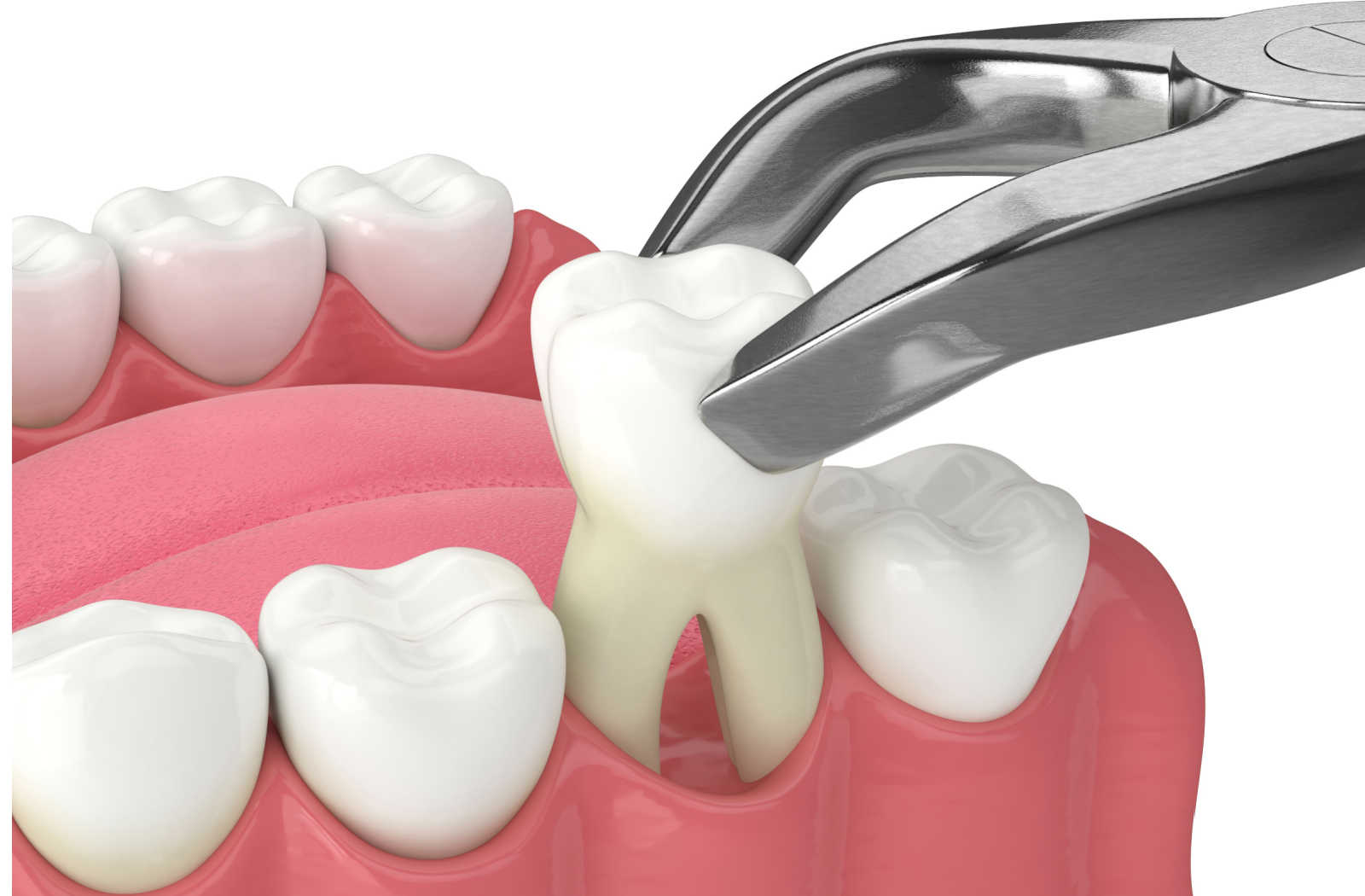 What-to-Eat-after-Tooth-Extraction What To Eat After Tooth Extraction