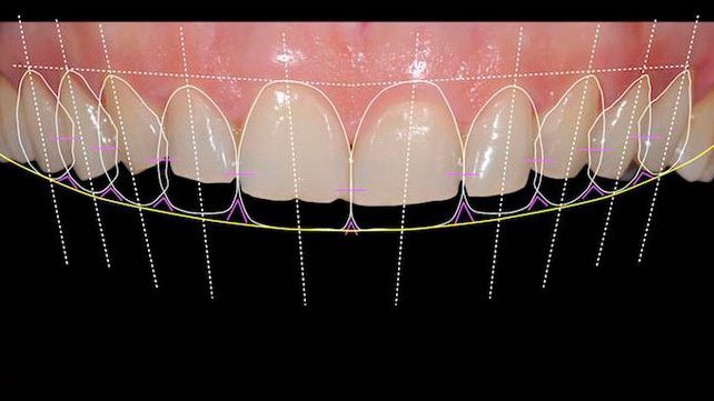 digital-smile-design1-img Digital Smile Design1 Img
