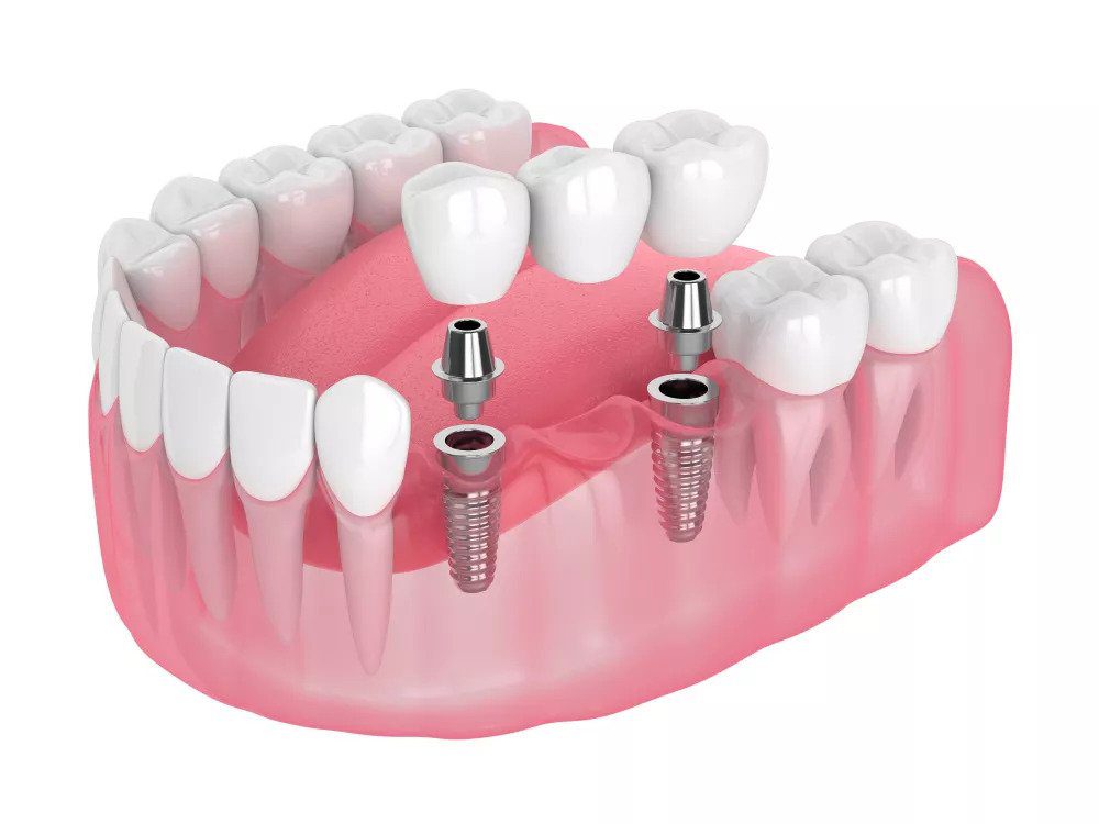 Implant Supported Bridge