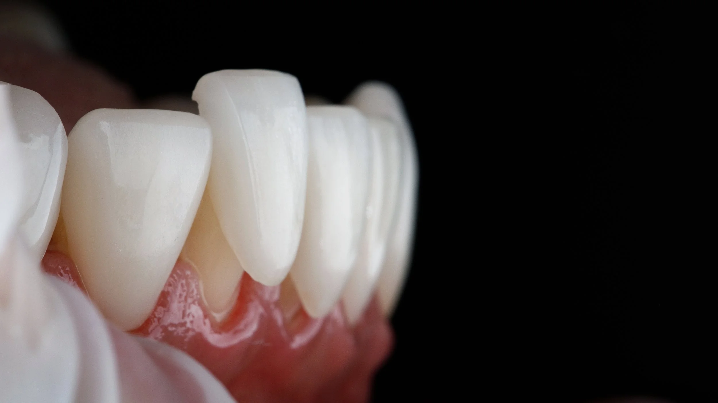 Dental Veneers On Lower Tooth.jpg