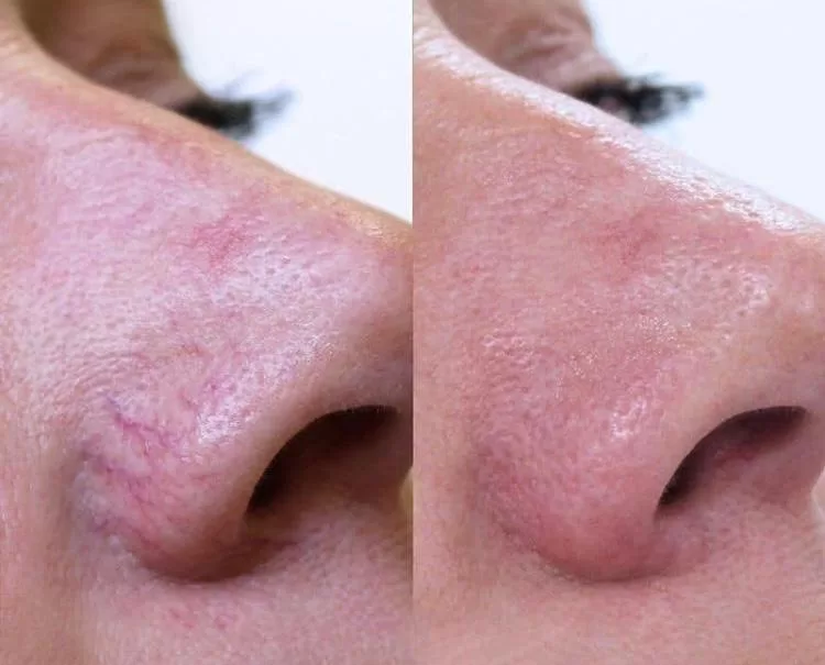 Thread Vein Treatment And Removal Before And After Jpg