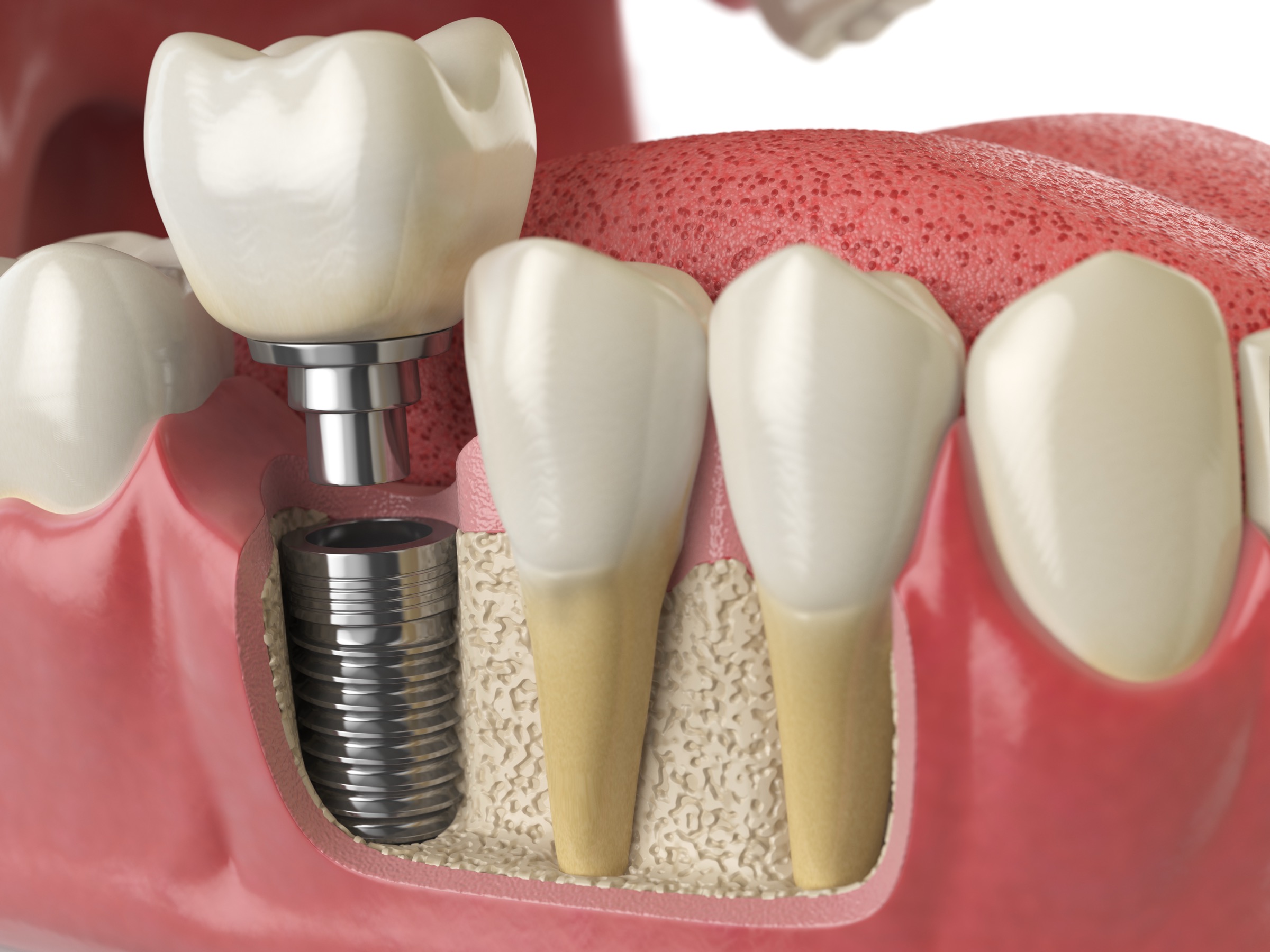 68b19d2e6a48463b20a7aeaa_Implant crown 68b19d2e6a48463b20a7aeaa Implant Crown