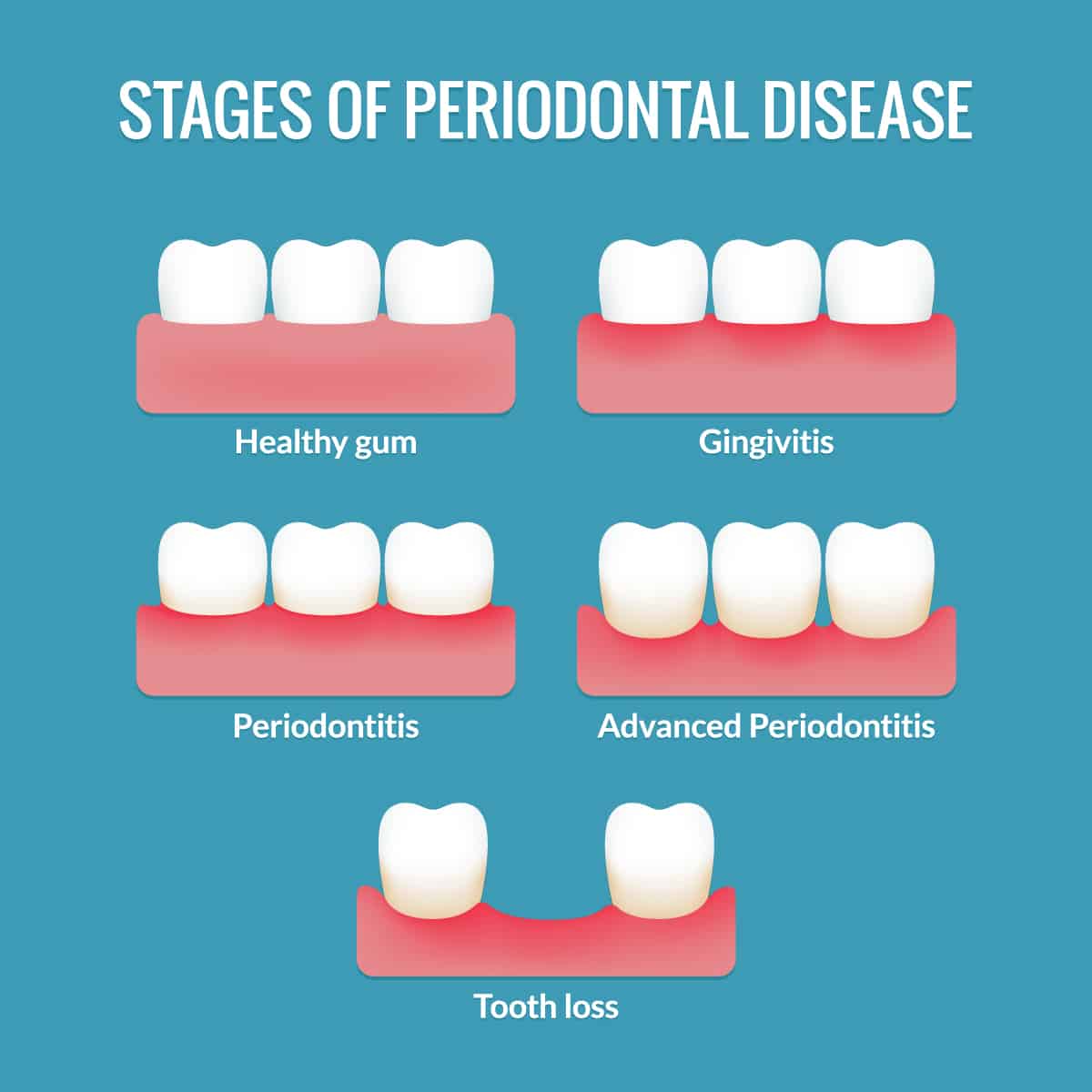 periodontal-disease-beachside-dental-group Periodontal Disease Beachside Dental Group