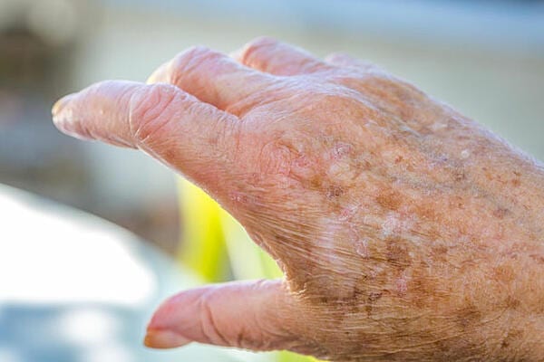 age-spots Age Spots
